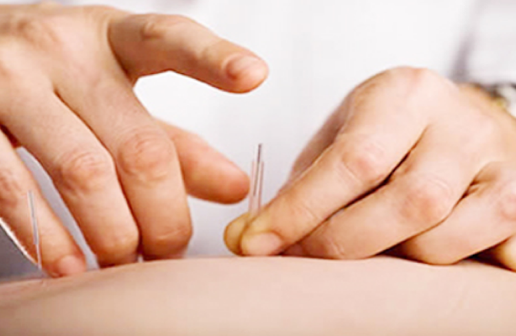 Điện mãng châm điều trị rối loạn tiêu hóa (Tiết tả)